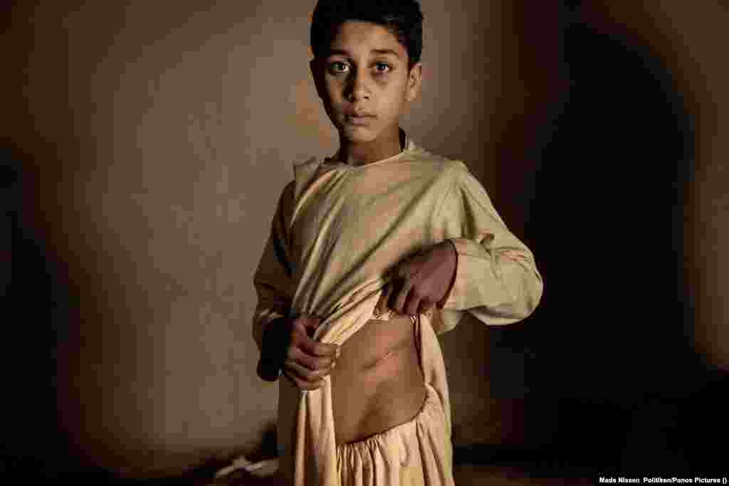 Khalil Ahmad, 15, poses in Herat, Afghanistan, on January 19, 2022, after his parents sold his kidney for&nbsp;$3,500 in order to afford food for the family.&nbsp;The lack of jobs and the threat of starvation has led to a dramatic increase in the illegal organ trade in Afghanistan. World Press Photo Story of the Year:&nbsp;The Price Of Peace In Afghanistan by&nbsp;Mads Nissen, Politiken/Panos Pictures